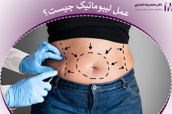 لیپوماتیک چیست
