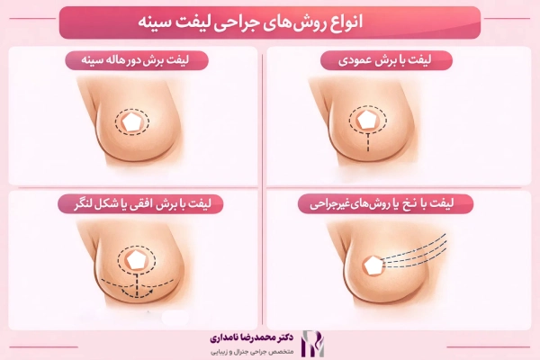 انواع روشهای جراحی لیفت سینه