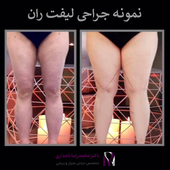 عمل لیفت ران