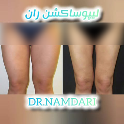 لیپوساکشن ران پا
