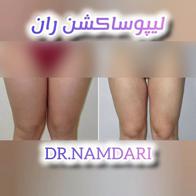 تصویر لیپوساکشن ران پا