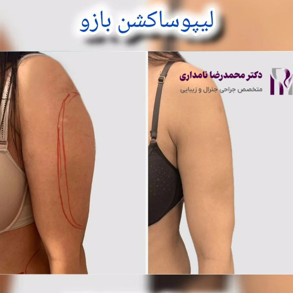 نمونه لیپوساکشن بازو