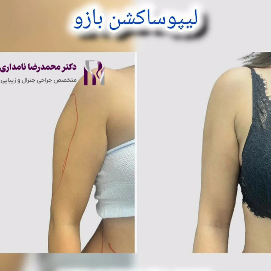 نمونه عمل لیپوساکشن بازو