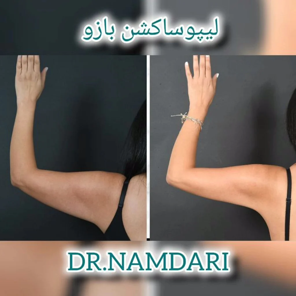 لیپوساکشن بازو دکتر نامداری