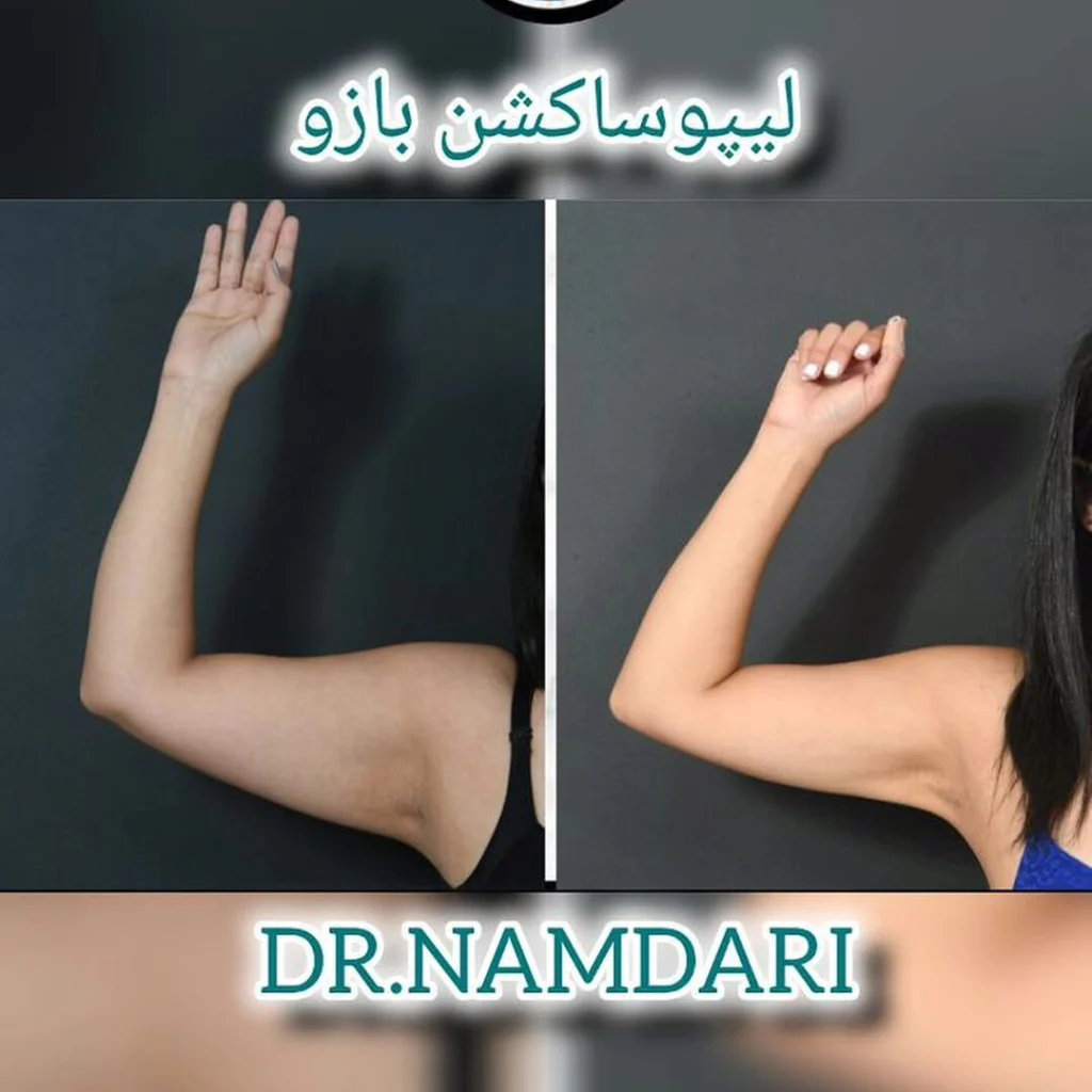 لیپوساکشن بازو توسط دکتر نامداری